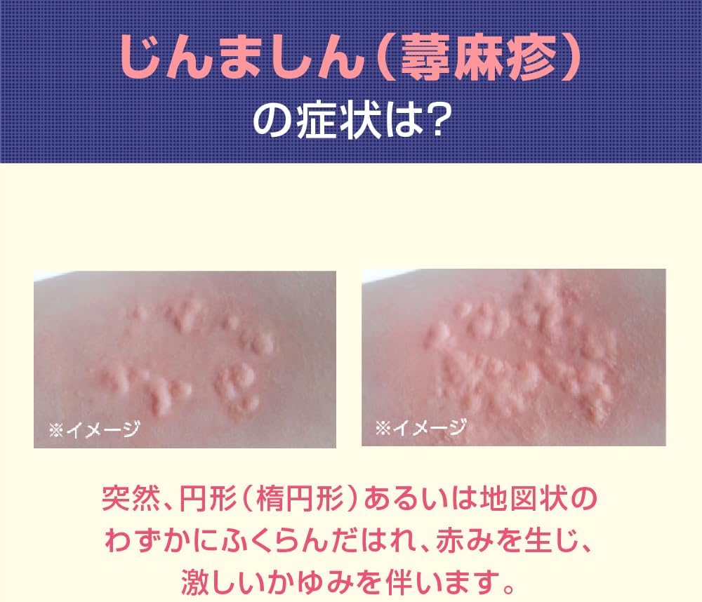 曼秀雷敦 蕁麻疹口服錠 14錠